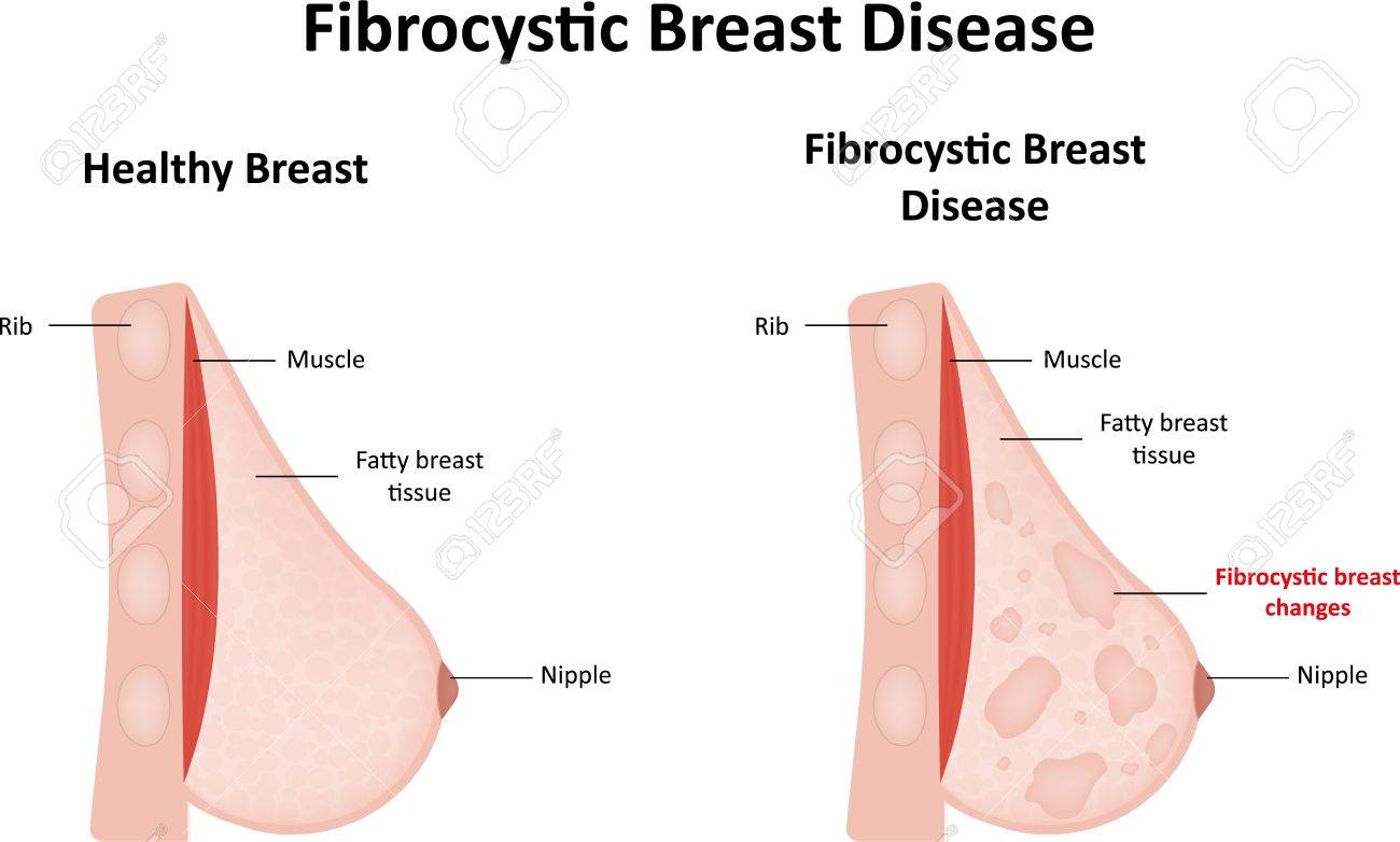 Fibrocystic breast changes 0 (0)