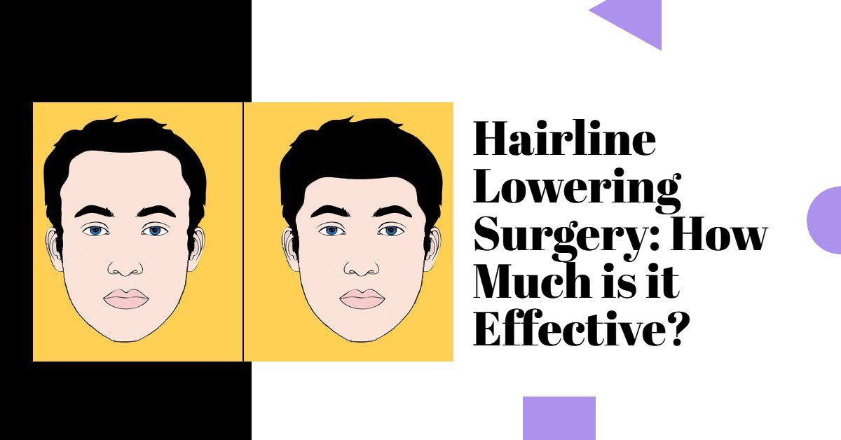 Hairline Lowering Surgery: How Much is it Effective?