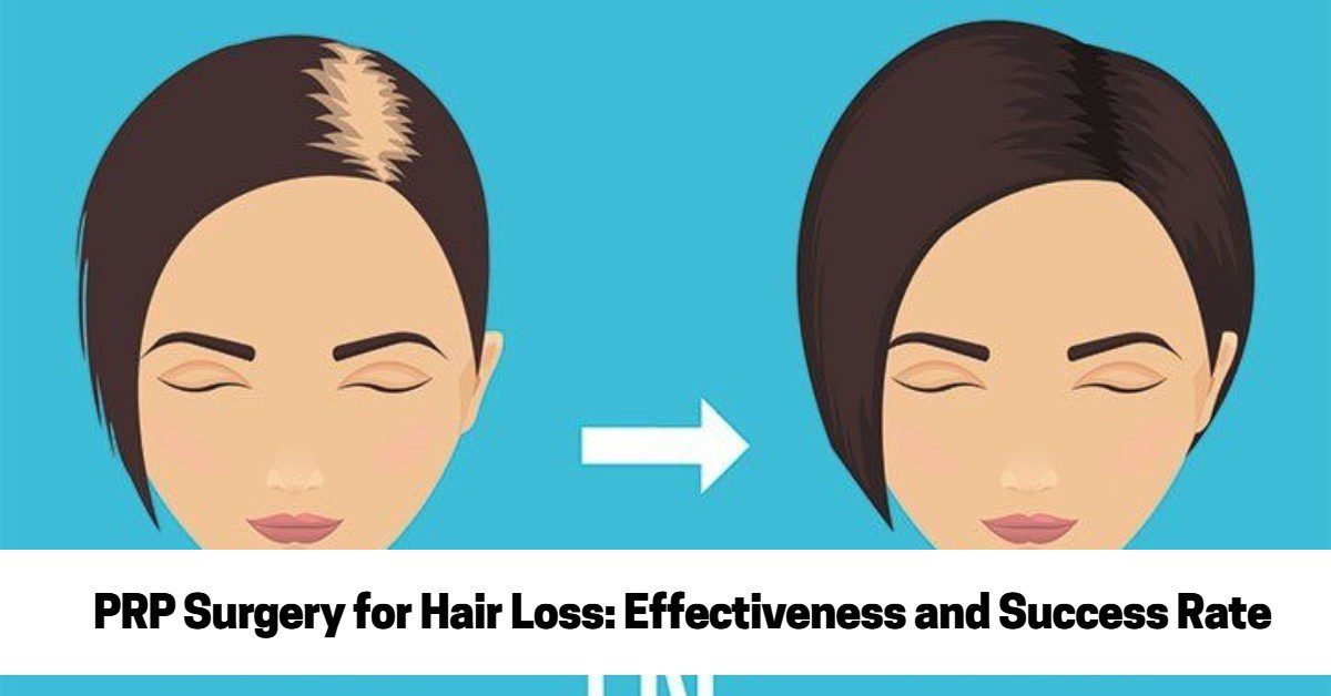 PRP Surgery for Hair Loss: Effectiveness and Success Rate