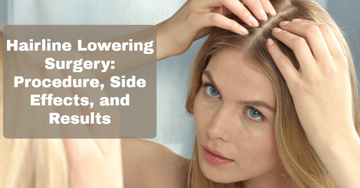 Hairline Lowering Surgery: Procedure, Side Effects, and Results