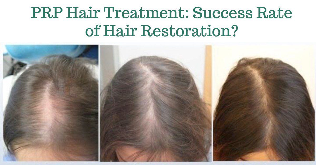 PRP Hair Treatment: Success Rate of Hair Restoration?